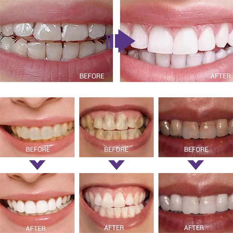 Pasta Dental Blanqueadora, Gel - Teeth Whitening Korea reseña y precio