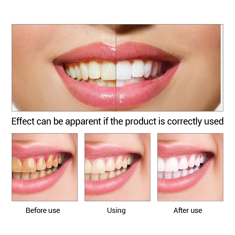FTEENPLY-esencia para blanquea - Teeth Whitening Results reseña y precio