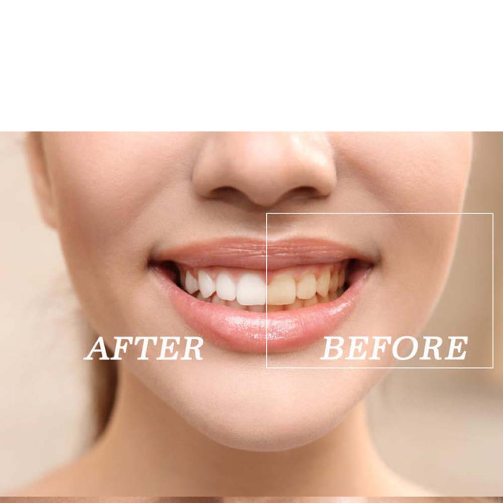Kit de Gel blanqueador de dien - Teeth Whitening Kit reseña y precio